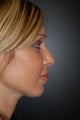 Rhinoplasty