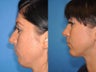 Rhinoplasty