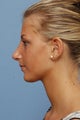 Rhinoplasty
