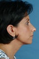 Rhinoplasty