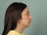 Rhinoplasty