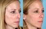 Rhinoplasty