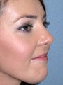 Rhinoplasty