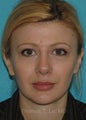 Rhinoplasty