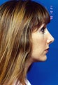 Rhinoplasty