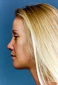 Rhinoplasty