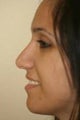 Rhinoplasty