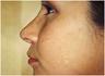Rhinoplasty