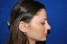 Rhinoplasty