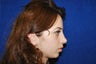Rhinoplasty