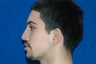 Rhinoplasty