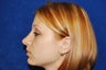 Rhinoplasty