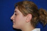 Rhinoplasty