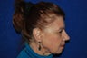 Rhinoplasty