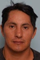 Ethnic Rhinoplasty (Male)