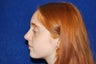 Rhinoplasty