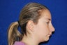 Rhinoplasty