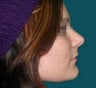 Rhinoplasty