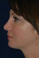 Rhinoplasty