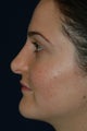 Rhinoplasty