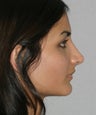 Rhinoplasty