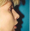 Rhinoplasty