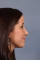 Rhinoplasty