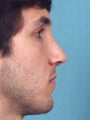 Rhinoplasty