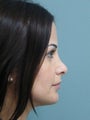 Rhinoplasty
