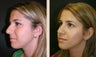 Rhinoplasty