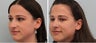 Primary Rhinoplasty