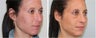 Before and After Rhinoplasty - 2 weeks post op