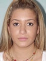 Rhinoplasty
