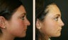 Rhinoplasty