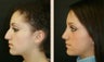 Rhinoplasty