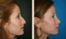 Rhinoplasty