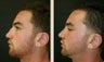 Rhinoplasty