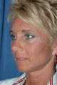Rhinoplasty