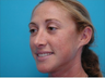 Rhinoplasty
