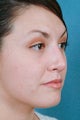 Rhinoplasty