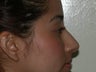Rhinoplasty