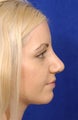 Rhinoplasty