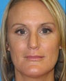 Rhinoplasty