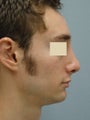 Rhinoplasty