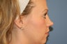 Rhinoplasty
