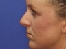 Rhinoplasty