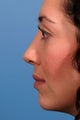 Rhinoplasty