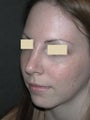 Rhinoplasty