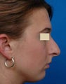 Rhinoplasty