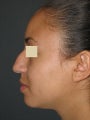 Rhinoplasty